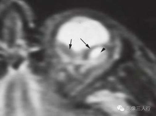 【病例】出血性视网膜脱离1例MR影像表现 【病例】出血性视网膜脱离1例MR影像表现