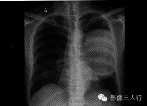 【病例】肺癌肉瘤1例X线CT影像表现 【病例】肺癌肉瘤1例X线CT影像表现