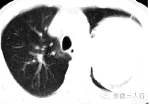 【病例】肺癌肉瘤1例X线CT影像表现 【病例】肺癌肉瘤1例X线CT影像表现