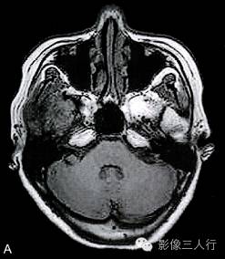 【病例】颅骨巨细胞炎性肉芽肿1例CT及MR影像表现分析