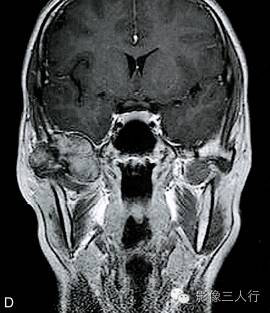 【病例】颅骨巨细胞炎性肉芽肿1例CT及MR影像表现分析