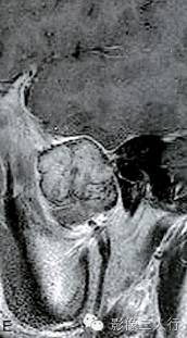 【病例】颅骨巨细胞炎性肉芽肿1例CT及MR影像表现分析