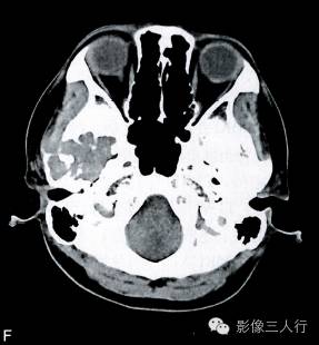 【病例】颅骨巨细胞炎性肉芽肿1例CT及MR影像表现分析