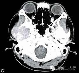 【病例】颅骨巨细胞炎性肉芽肿1例CT及MR影像表现分析