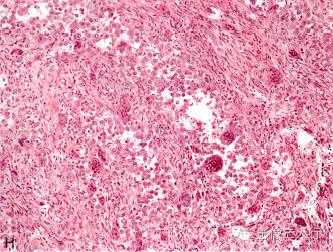【病例】颅骨巨细胞炎性肉芽肿1例CT及MR影像表现分析