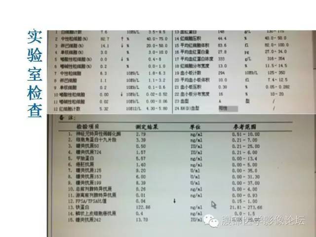 【病例】左侧睾丸及精索结核1例CT及MR 【病例】左侧睾丸及精索结核1例CT及MR