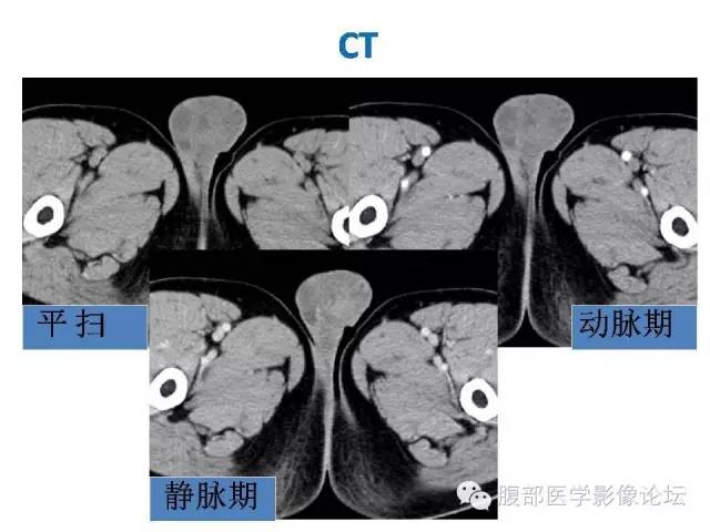 【病例】左侧睾丸及精索结核1例CT及MR 【病例】左侧睾丸及精索结核1例CT及MR