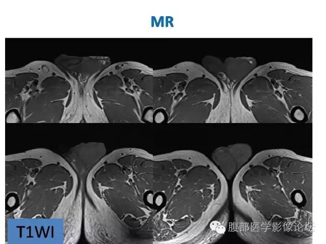 【病例】左侧睾丸及精索结核1例CT及MR 【病例】左侧睾丸及精索结核1例CT及MR
