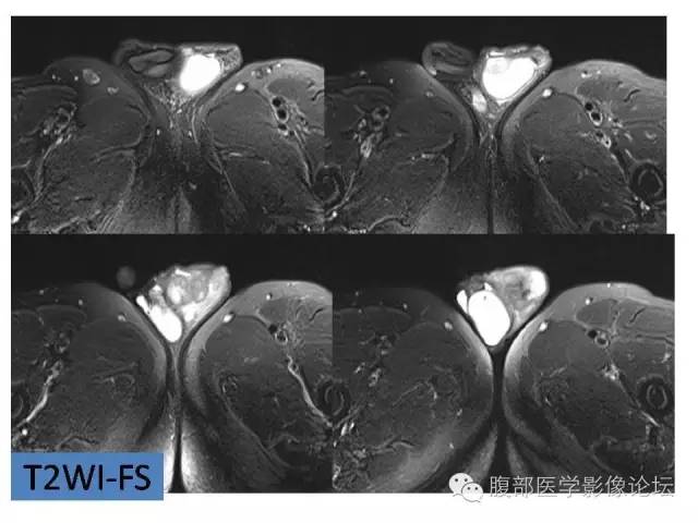 【病例】左侧睾丸及精索结核1例CT及MR 【病例】左侧睾丸及精索结核1例CT及MR