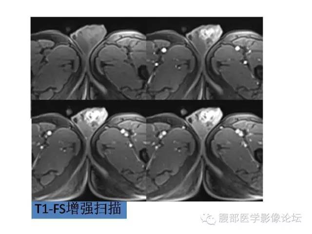【病例】左侧睾丸及精索结核1例CT及MR 【病例】左侧睾丸及精索结核1例CT及MR