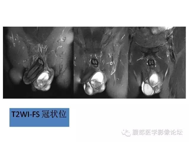 【病例】左侧睾丸及精索结核1例CT及MR 【病例】左侧睾丸及精索结核1例CT及MR