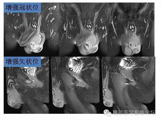 【病例】左侧睾丸及精索结核1例CT及MR 【病例】左侧睾丸及精索结核1例CT及MR