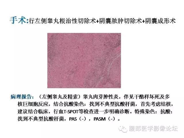 【病例】左侧睾丸及精索结核1例CT及MR 【病例】左侧睾丸及精索结核1例CT及MR