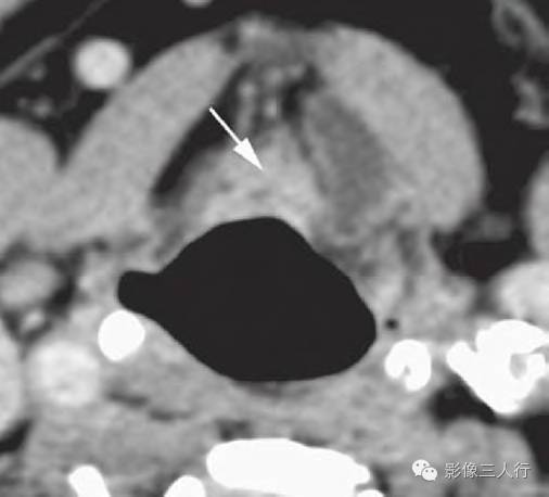 【病例】梗阻性肿瘤造成的喉内型喉气囊肿1例CT影像表现