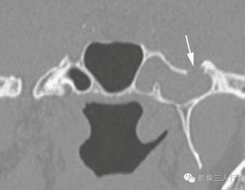 【病例】蝶窦骨质缺损继发CSF鼻漏及脑膨出1例CT及MR
