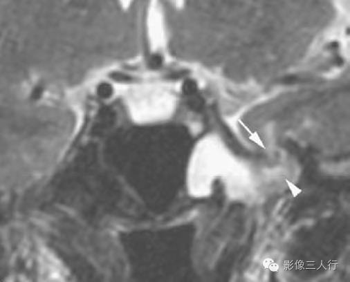 【病例】蝶窦骨质缺损继发CSF鼻漏及脑膨出1例CT及MR 【病例】蝶窦骨质缺损继发CSF鼻漏及脑膨出1例CT及MR