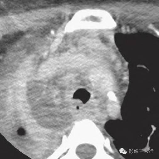 【病例】咽炎合并广泛积脓或脓肿1例CT 【病例】咽炎合并广泛积脓或脓肿1例CT