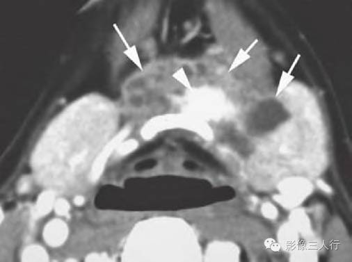 【病例】甲状舌管残留伴起源于异位甲状腺组织的甲状腺癌1例