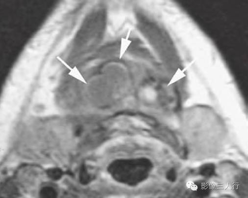 【病例】甲状舌管残留伴起源于异位甲状腺组织的甲状腺癌1例