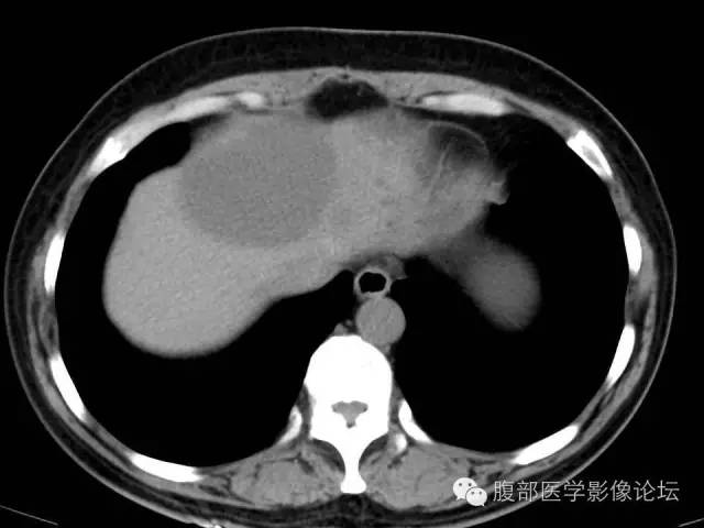 【病例】肝内胆管囊腺瘤1例CT影像表现 【病例】肝内胆管囊腺瘤1例CT影像表现
