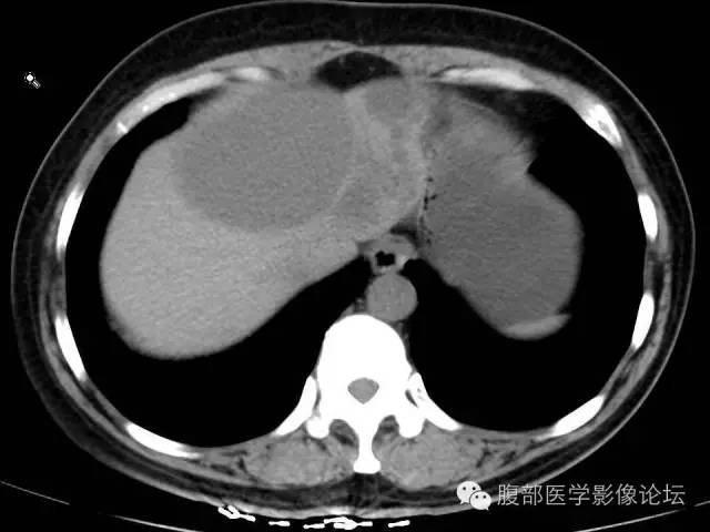 【病例】肝内胆管囊腺瘤1例CT影像表现 【病例】肝内胆管囊腺瘤1例CT影像表现