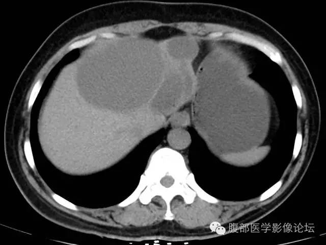 【病例】肝内胆管囊腺瘤1例CT影像表现 【病例】肝内胆管囊腺瘤1例CT影像表现
