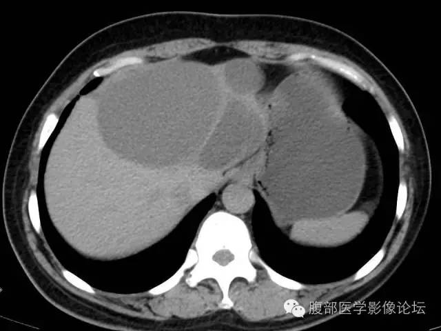 【病例】肝内胆管囊腺瘤1例CT影像表现 【病例】肝内胆管囊腺瘤1例CT影像表现