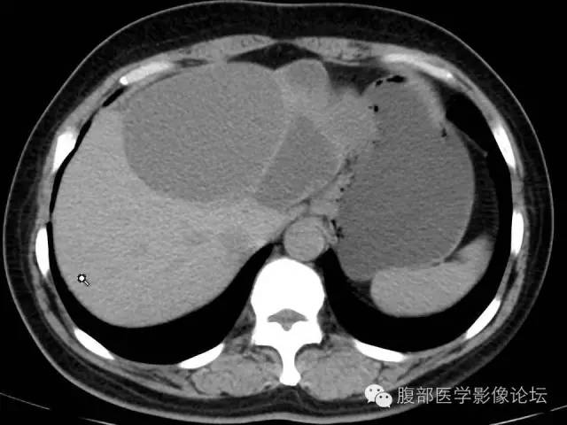 【病例】肝内胆管囊腺瘤1例CT影像表现 【病例】肝内胆管囊腺瘤1例CT影像表现