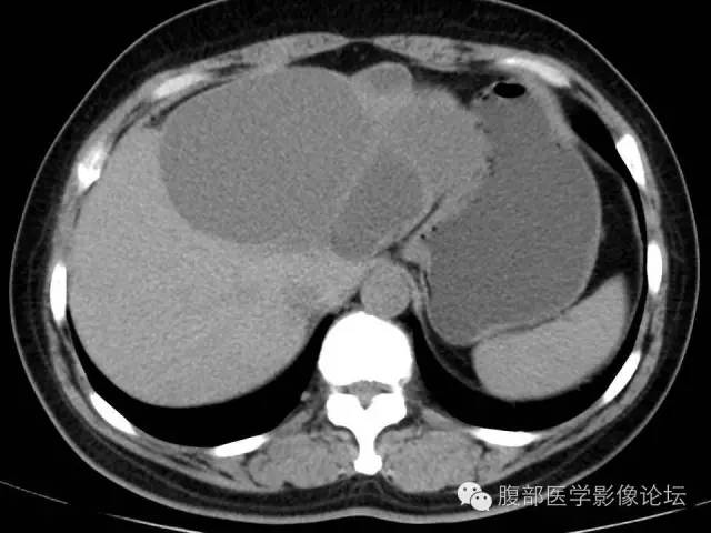 【病例】肝内胆管囊腺瘤1例CT影像表现 【病例】肝内胆管囊腺瘤1例CT影像表现