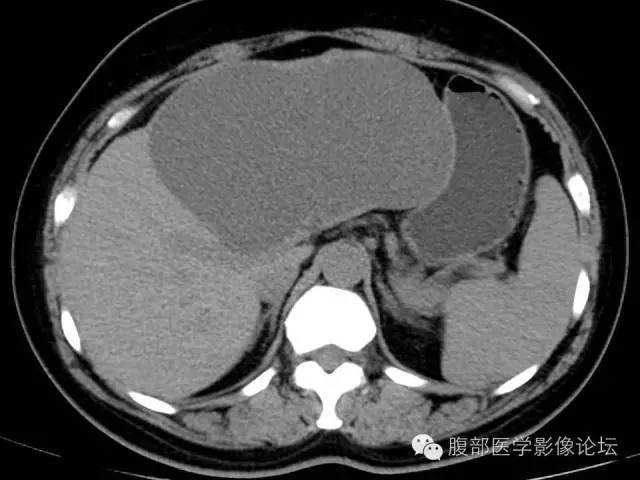 【病例】肝内胆管囊腺瘤1例CT影像表现 【病例】肝内胆管囊腺瘤1例CT影像表现