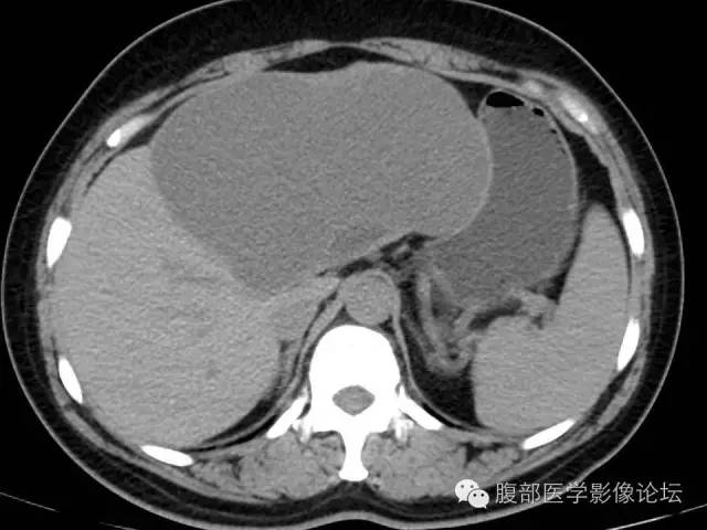 【病例】肝内胆管囊腺瘤1例CT影像表现 【病例】肝内胆管囊腺瘤1例CT影像表现