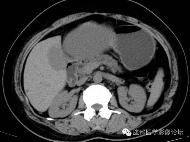 【病例】肝内胆管囊腺瘤1例CT影像表现 【病例】肝内胆管囊腺瘤1例CT影像表现