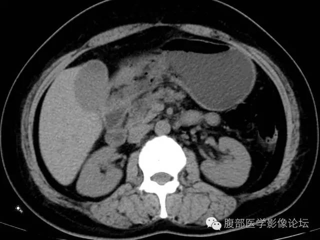 【病例】肝内胆管囊腺瘤1例CT影像表现 【病例】肝内胆管囊腺瘤1例CT影像表现