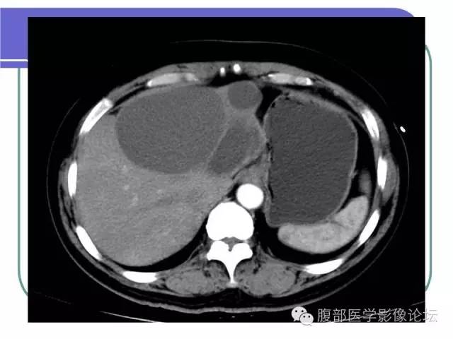 【病例】肝内胆管囊腺瘤1例CT影像表现 【病例】肝内胆管囊腺瘤1例CT影像表现