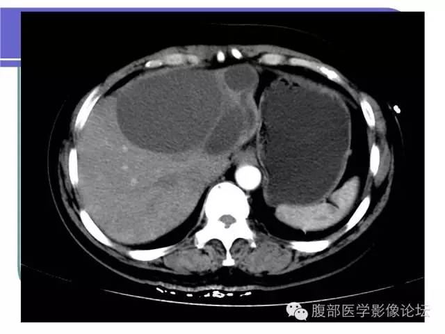 【病例】肝内胆管囊腺瘤1例CT影像表现 【病例】肝内胆管囊腺瘤1例CT影像表现