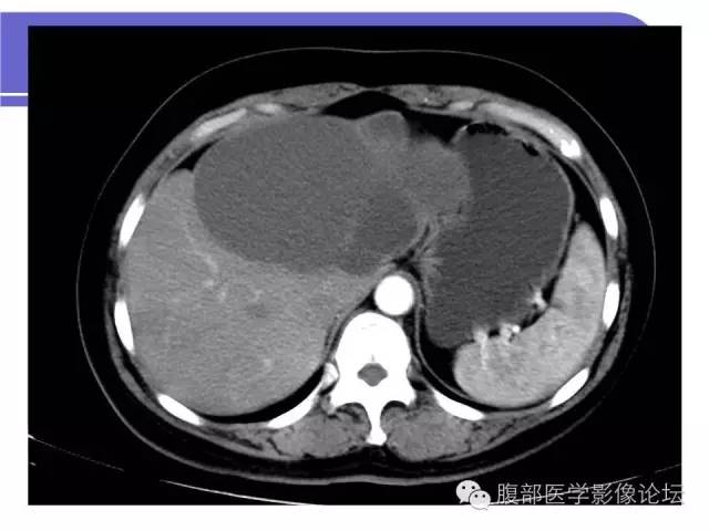 【病例】肝内胆管囊腺瘤1例CT影像表现 【病例】肝内胆管囊腺瘤1例CT影像表现