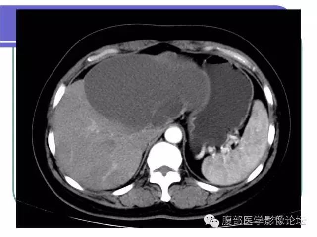 【病例】肝内胆管囊腺瘤1例CT影像表现 【病例】肝内胆管囊腺瘤1例CT影像表现