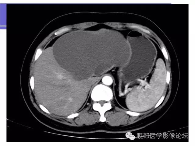 【病例】肝内胆管囊腺瘤1例CT影像表现 【病例】肝内胆管囊腺瘤1例CT影像表现