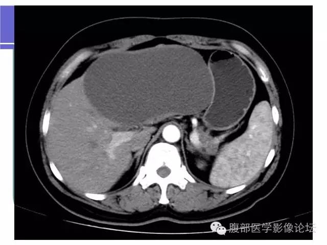 【病例】肝内胆管囊腺瘤1例CT影像表现 【病例】肝内胆管囊腺瘤1例CT影像表现