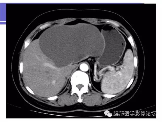 【病例】肝内胆管囊腺瘤1例CT影像表现 【病例】肝内胆管囊腺瘤1例CT影像表现
