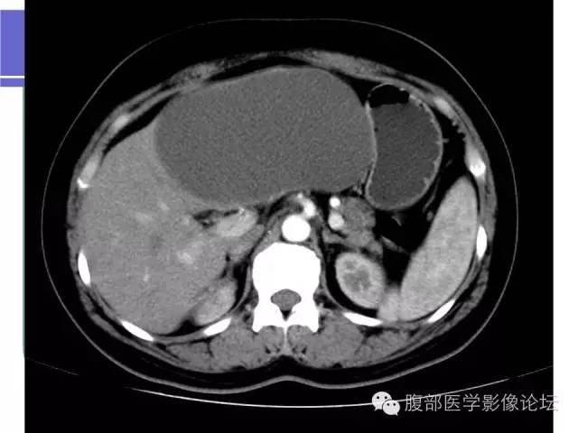 【病例】肝内胆管囊腺瘤1例CT影像表现 【病例】肝内胆管囊腺瘤1例CT影像表现