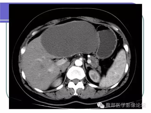 【病例】肝内胆管囊腺瘤1例CT影像表现 【病例】肝内胆管囊腺瘤1例CT影像表现