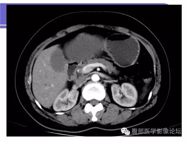 【病例】肝内胆管囊腺瘤1例CT影像表现 【病例】肝内胆管囊腺瘤1例CT影像表现