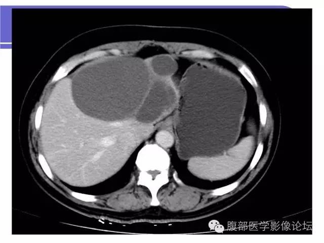 【病例】肝内胆管囊腺瘤1例CT影像表现 【病例】肝内胆管囊腺瘤1例CT影像表现