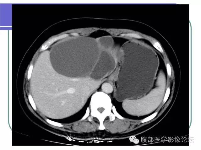 【病例】肝内胆管囊腺瘤1例CT影像表现 【病例】肝内胆管囊腺瘤1例CT影像表现