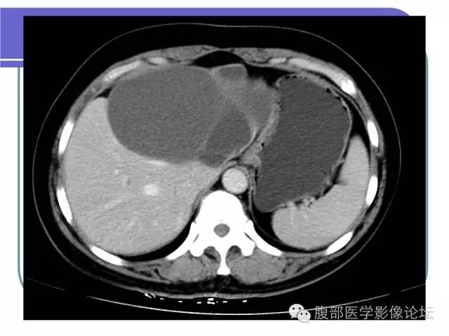 【病例】肝内胆管囊腺瘤1例CT影像表现 【病例】肝内胆管囊腺瘤1例CT影像表现