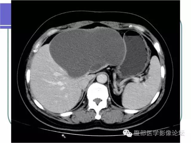 【病例】肝内胆管囊腺瘤1例CT影像表现 【病例】肝内胆管囊腺瘤1例CT影像表现