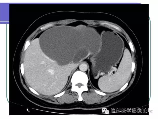 【病例】肝内胆管囊腺瘤1例CT影像表现 【病例】肝内胆管囊腺瘤1例CT影像表现