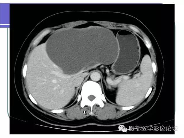 【病例】肝内胆管囊腺瘤1例CT影像表现 【病例】肝内胆管囊腺瘤1例CT影像表现