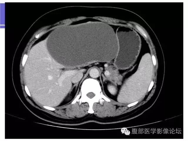 【病例】肝内胆管囊腺瘤1例CT影像表现 【病例】肝内胆管囊腺瘤1例CT影像表现